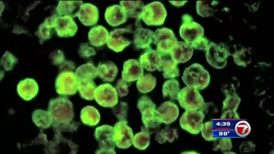 Pediatric patient dies from brain-eating amoeba in South Carolina, officials say